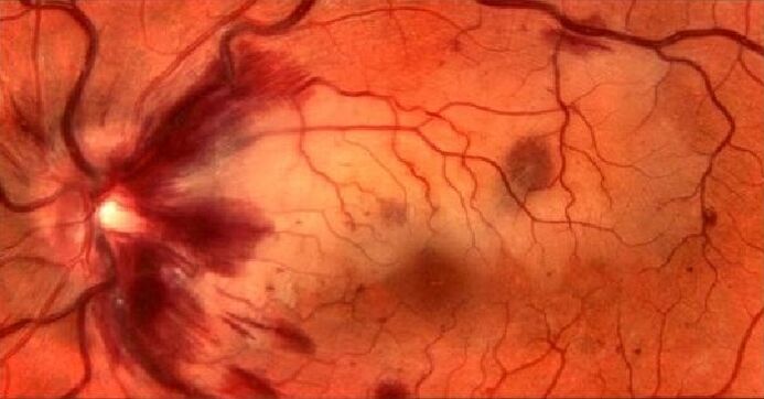 retina erek és a látás helyreállítása